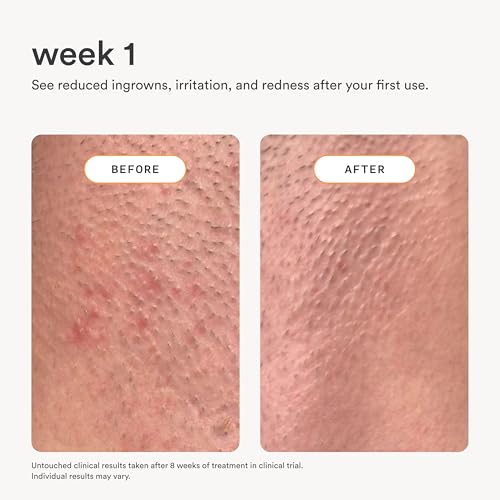 Nood NEW Serum — Slows Hair Regrowth, Shave Less — After Shave Oil Treats & Prevents Ingrown Hairs, Razor Bumps, Hair Cysts — Visible Results After First Use & Works Wherever Hair Grows